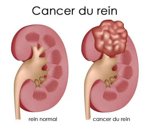 Cancer du rein